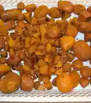 Gallstones
